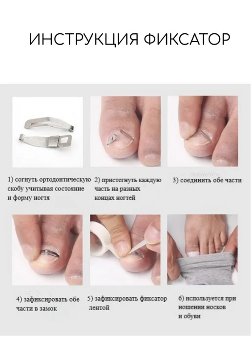 4opaShop корректор вросшего ногтя, серый, фото 4