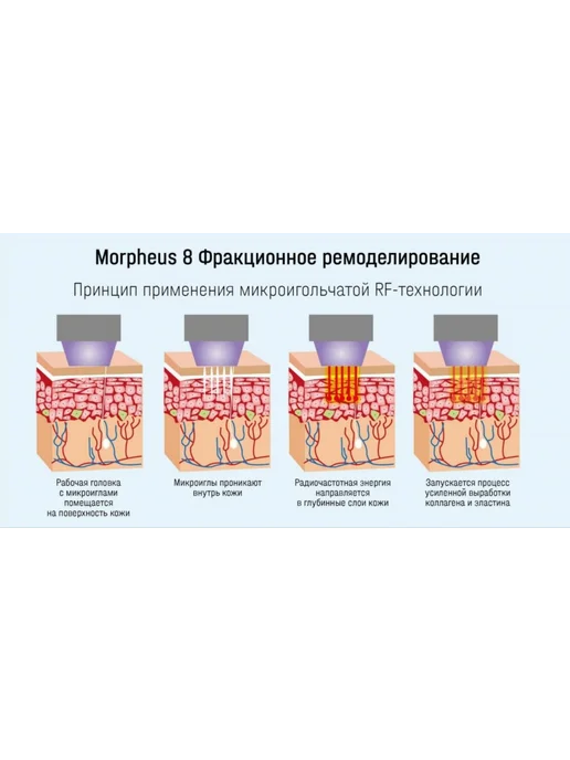 Beauty Style М Насадка 40 игл для аппарата микроигольчатого RF-лифтинга, вариант, фото 3